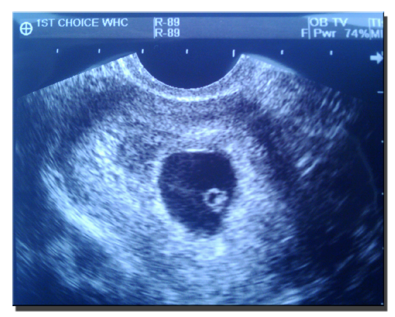baby-ultrasound